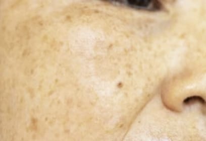 広島のシミ取り「老人性色素斑」ケア