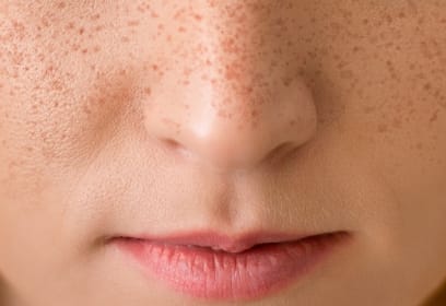 広島のシミ取り「そばかす」ケア