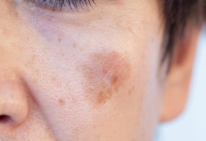 広島のシミ取り「肝斑」ケア