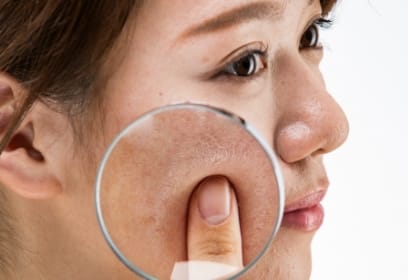 広島のシミ取り「くすみ」ケア