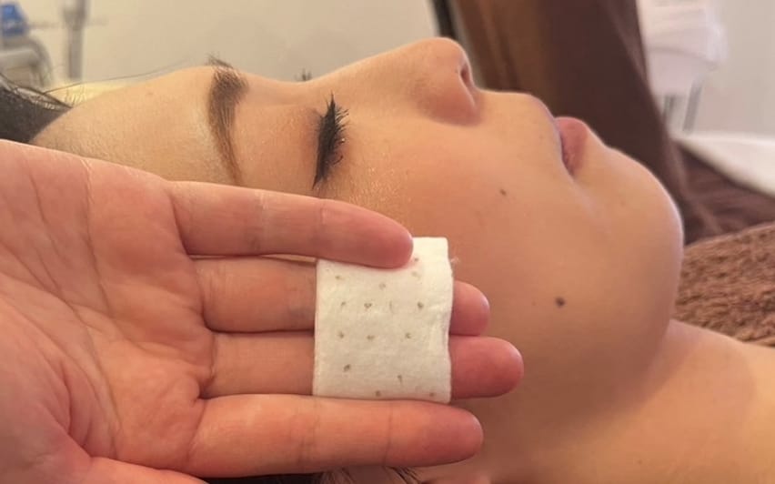 広島のシミ取り2回体験コースの一例