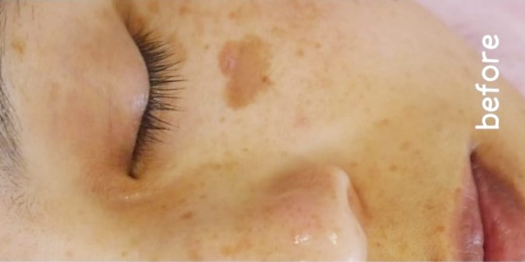 広島のシミ取り2回体験コースの施術前1