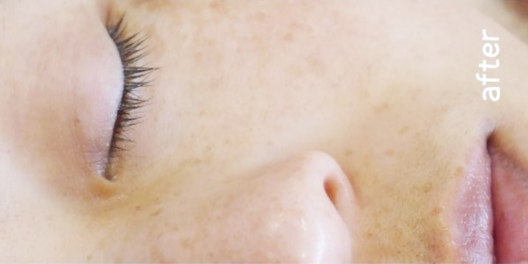 広島のシミ取り2回体験コースの施術後1