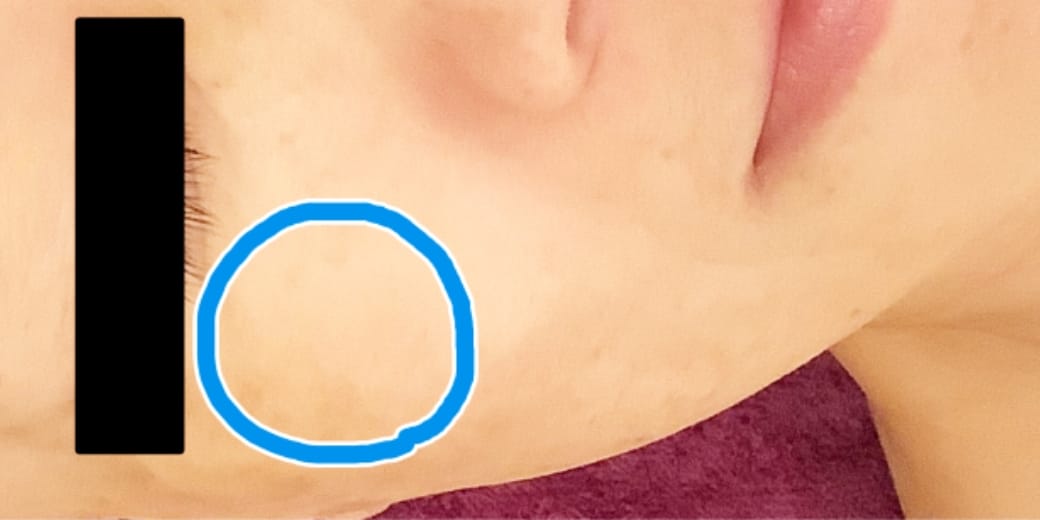 広島のシミ取り2回体験コースの施術後2