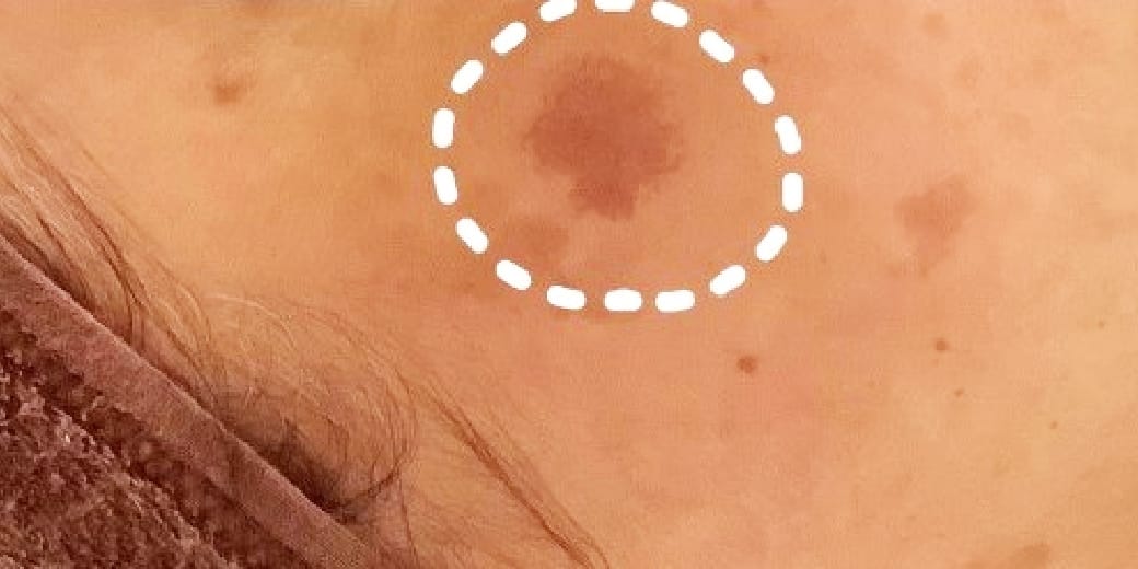 広島のシミ取り2回体験コースの施術前3