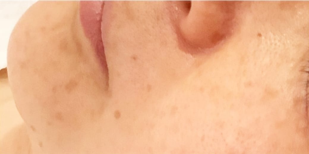 広島のシミ取り2回体験コースの施術前4