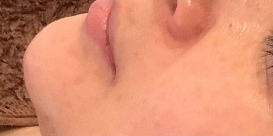 広島のシミ取り2回体験コースの施術後4