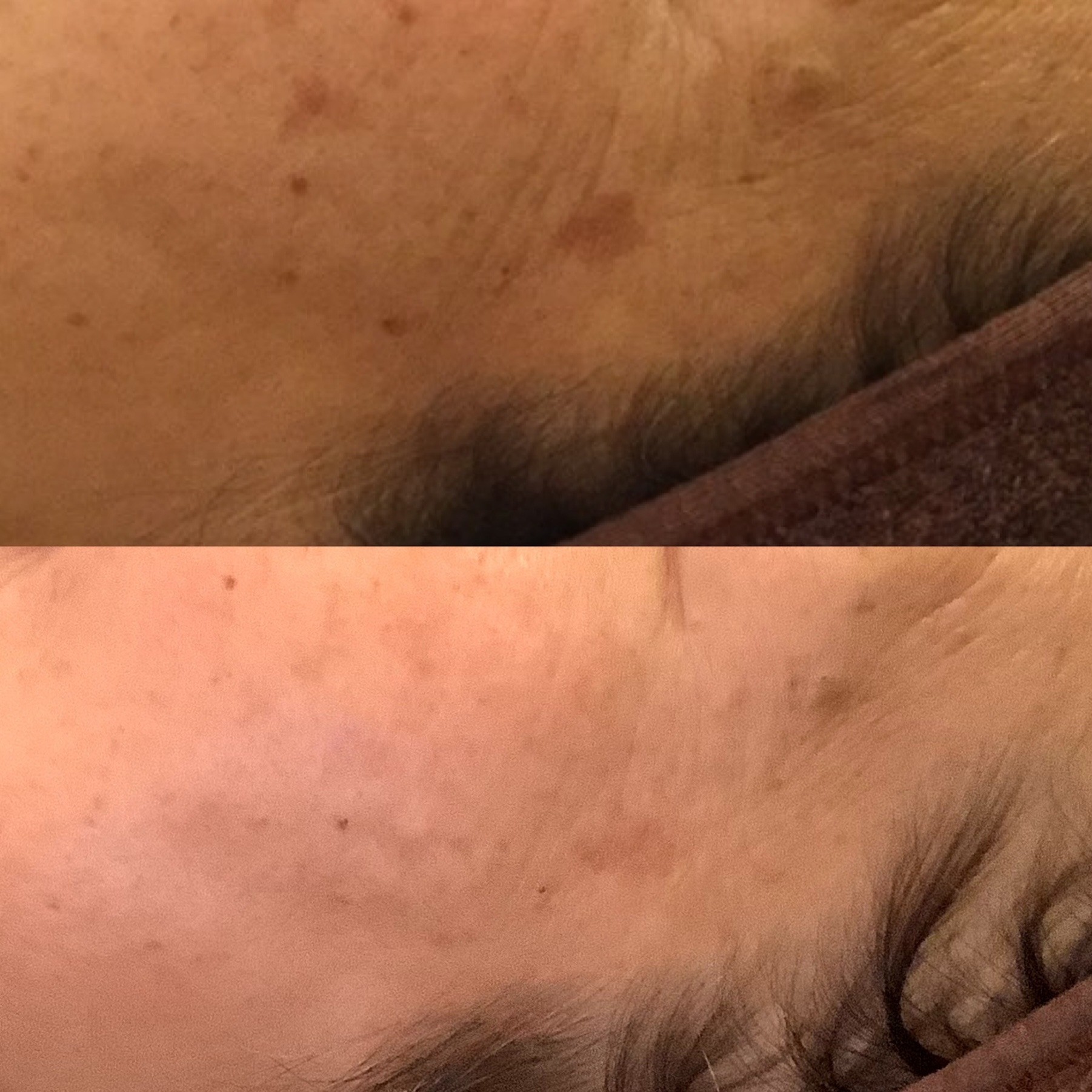 シミ取りエステ　シミ取り放題