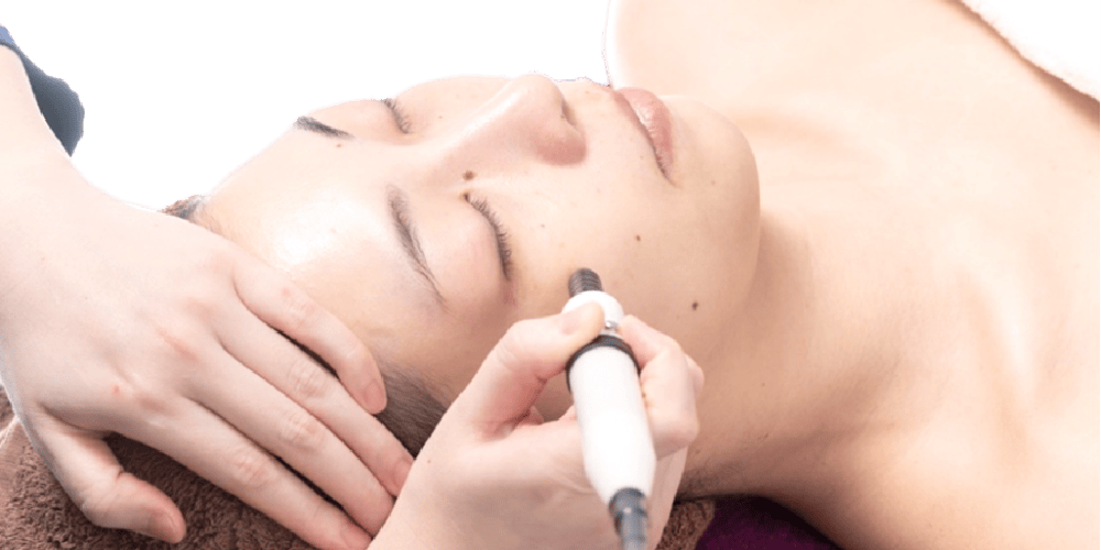 シミ取り　エステシミ取り