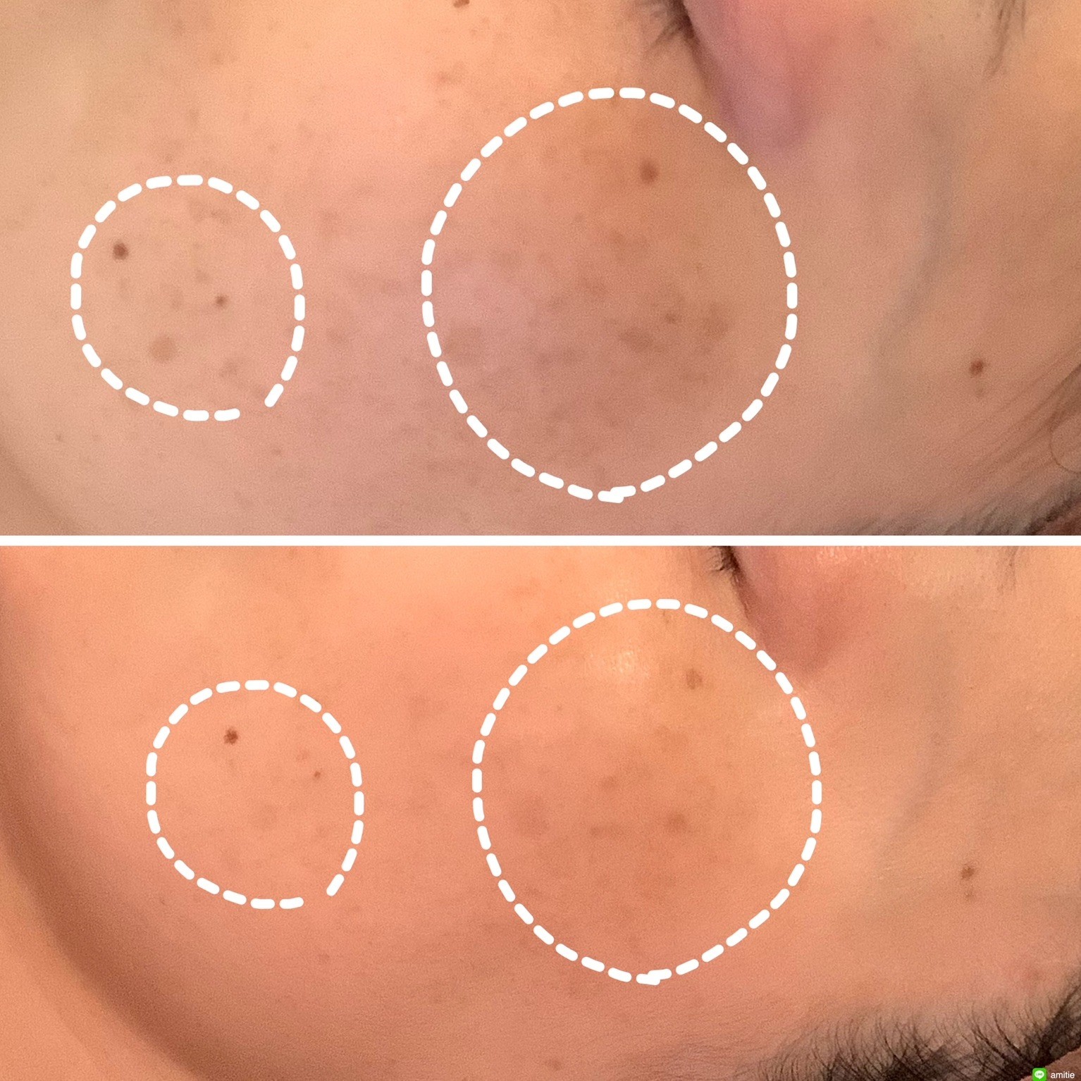 シミ結果　広島エステ