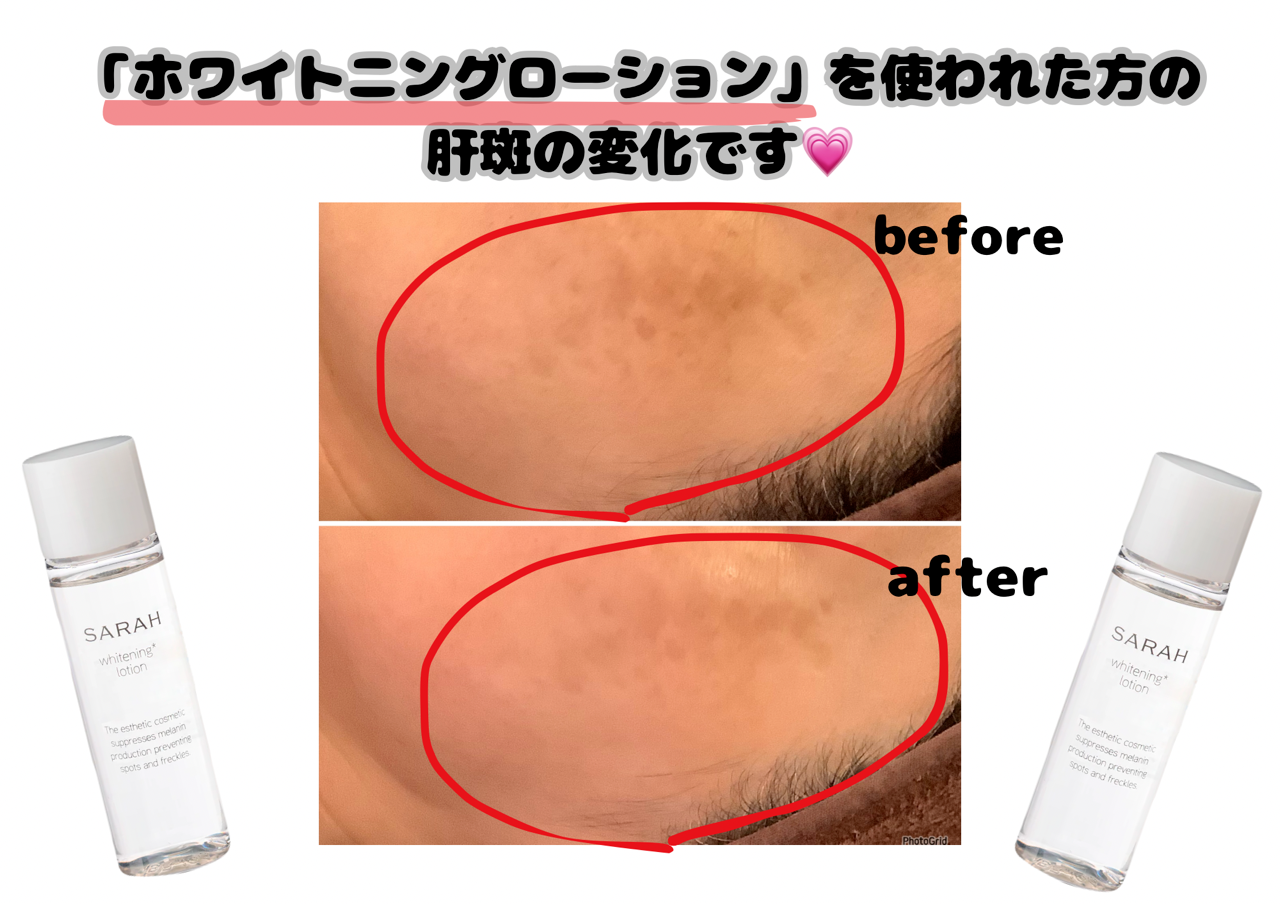 シミ取り　肝斑