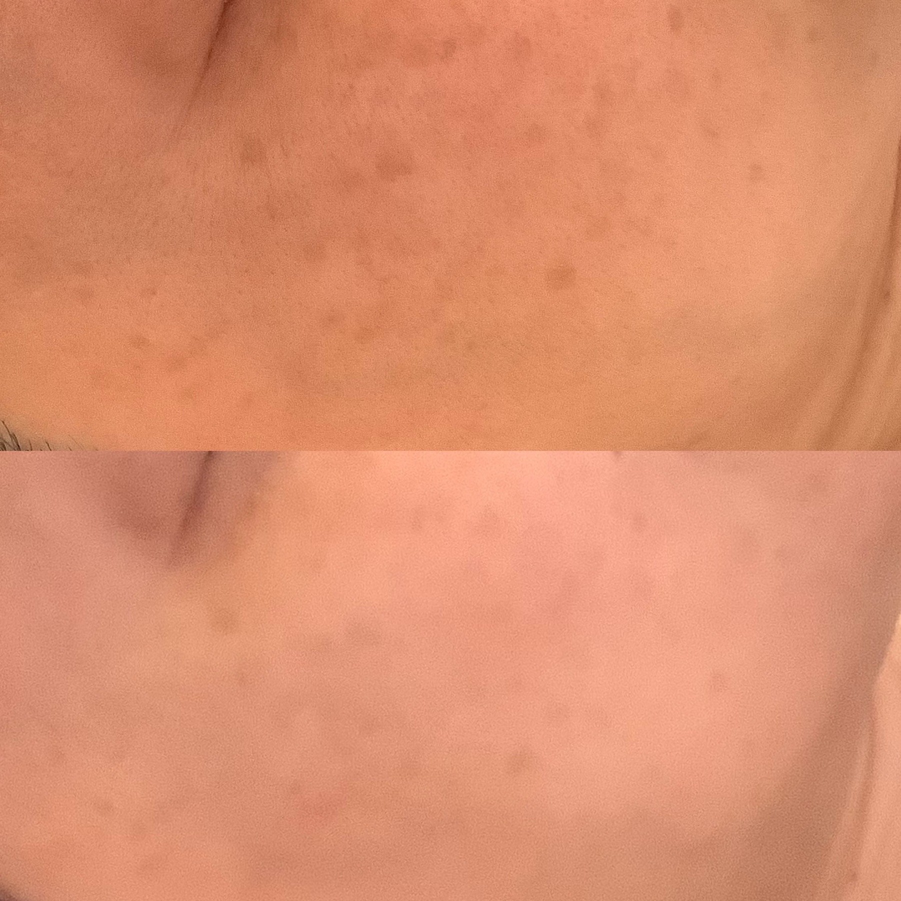 シミ取り結果　広島エステ