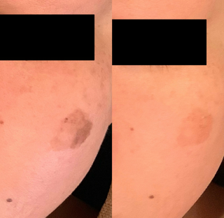 シミ取り結果　広島エステ