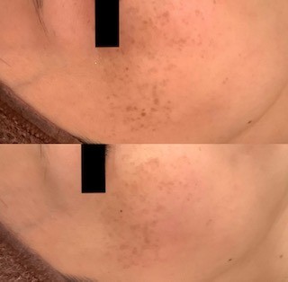 シミ取りエステ　そばかす取り