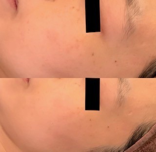 シミ取りエステ　シミ取り