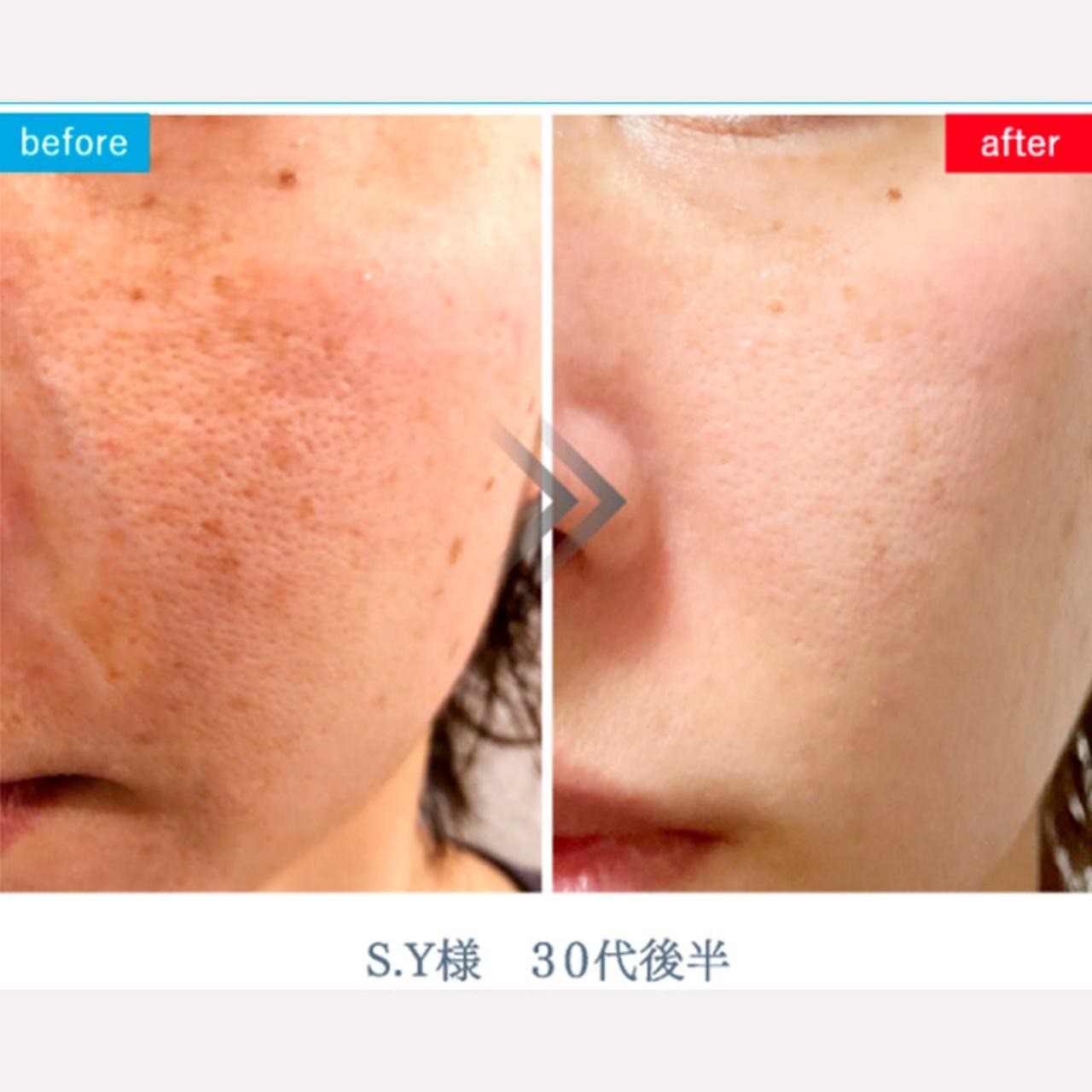 シミ取り　毛穴　そばかす