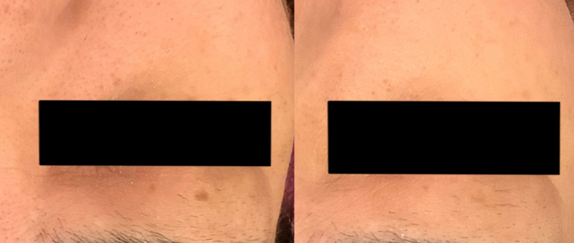 シミ取りエステ　広島エステ