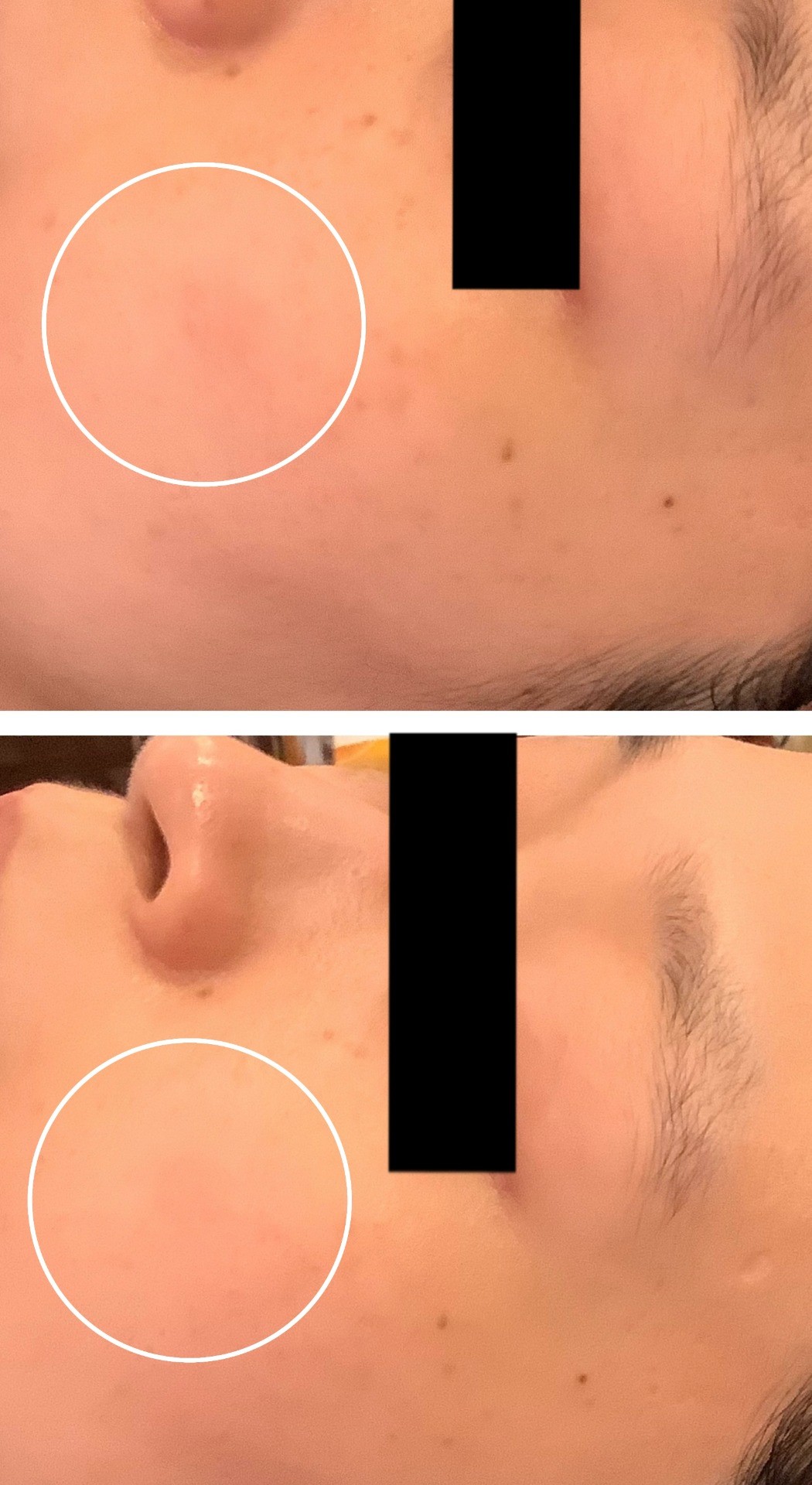 シミ取り　エステシミ取り