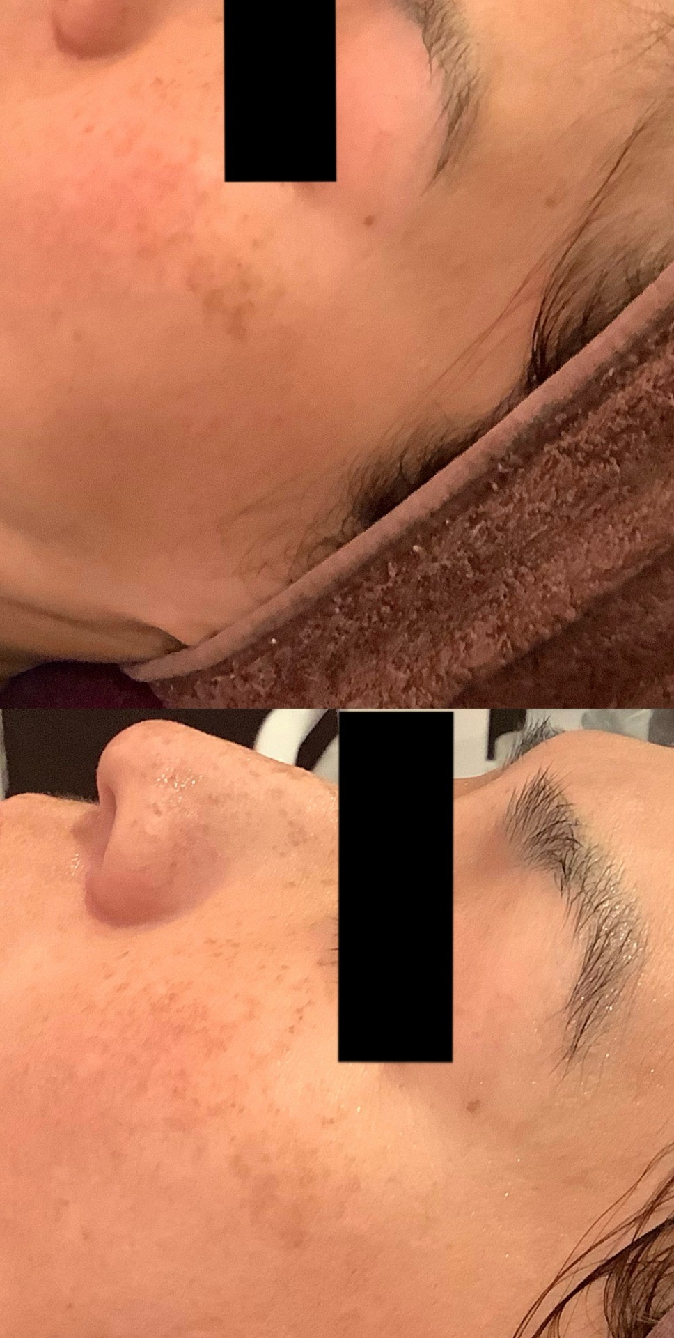 シミ取りエステ　シミ取り