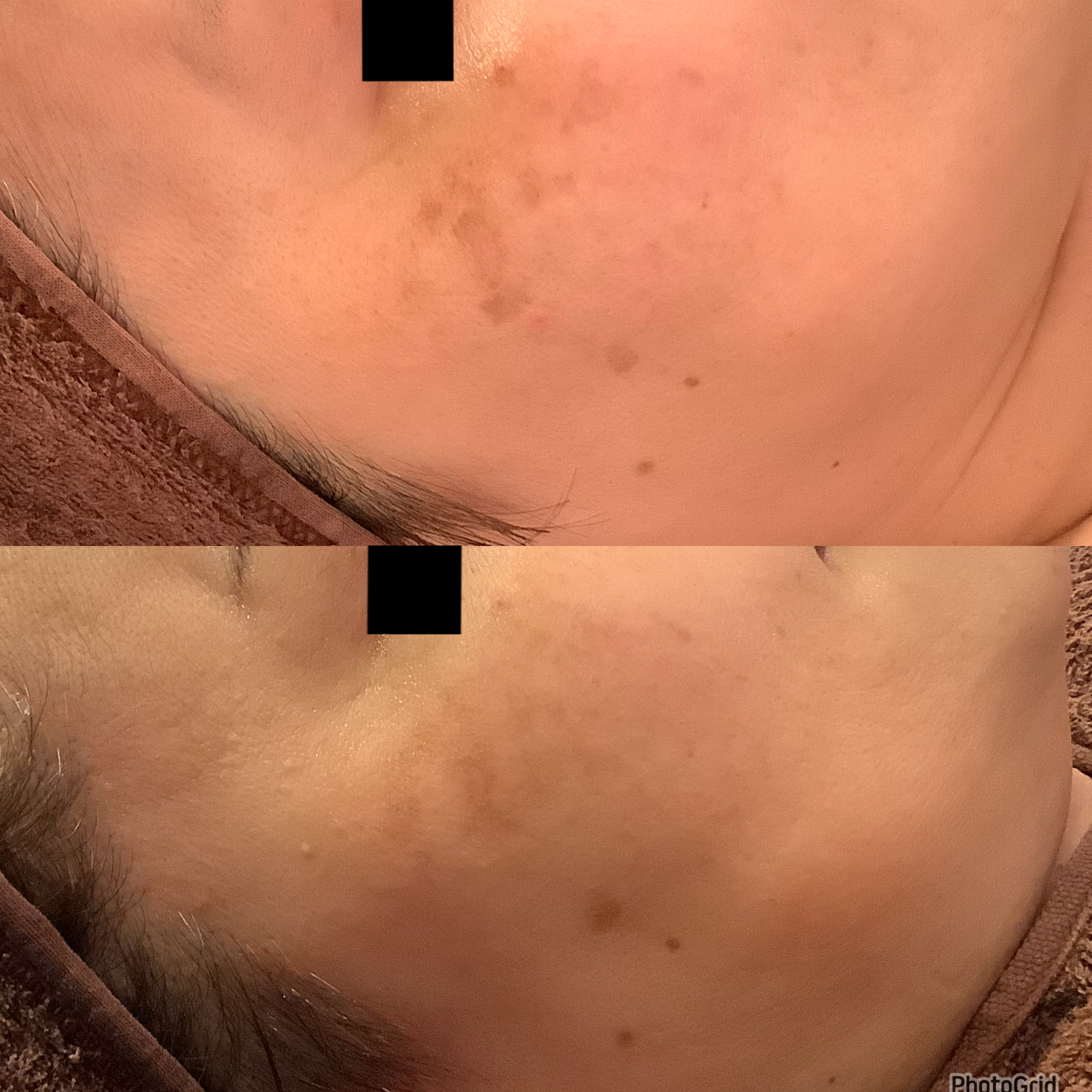 シミ取りエステ　シミ取り