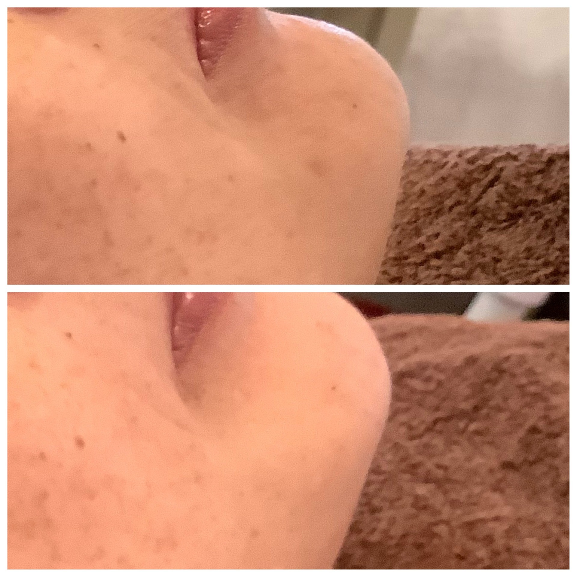 シミ取りエステ　シミシワたるみ