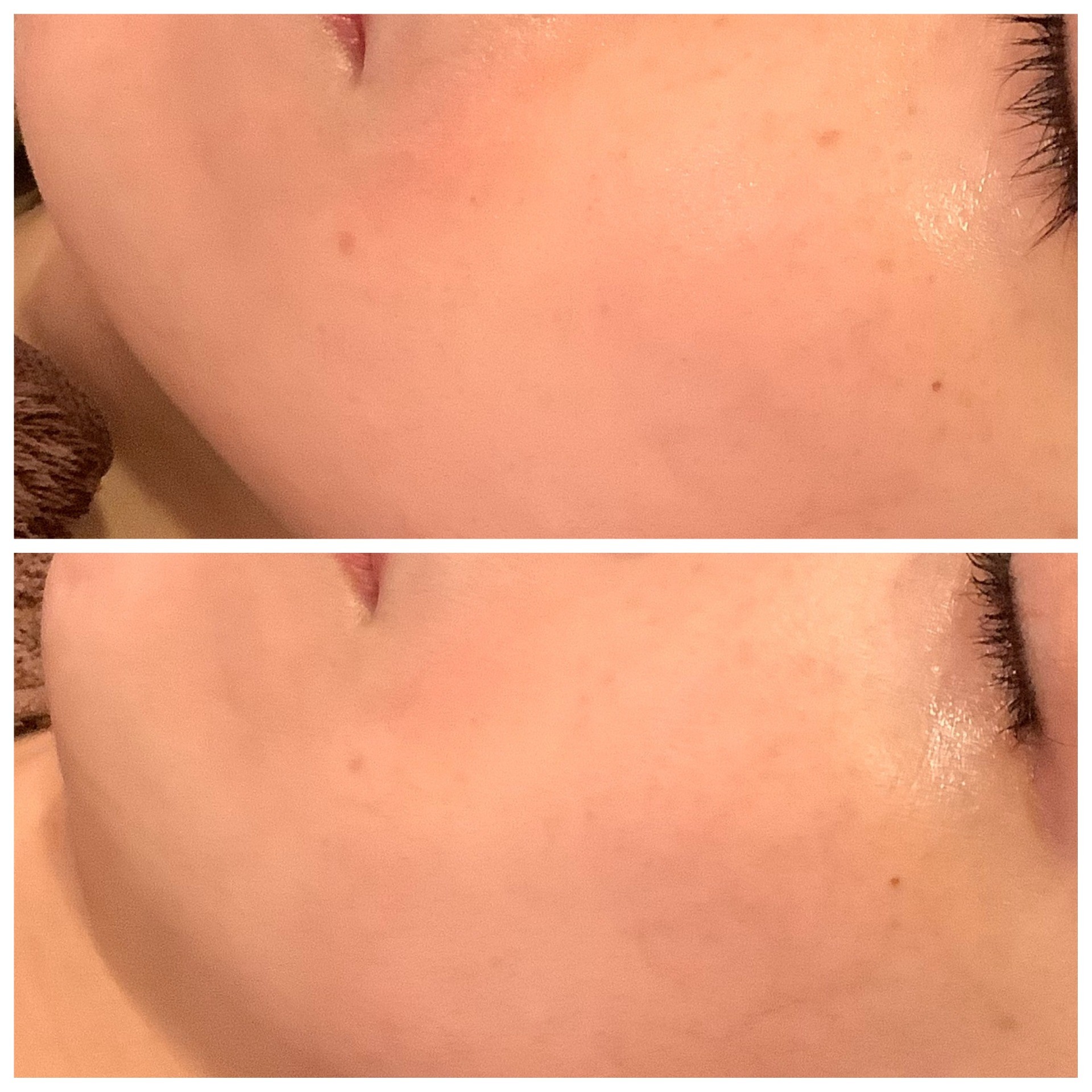 シミ取りエステ