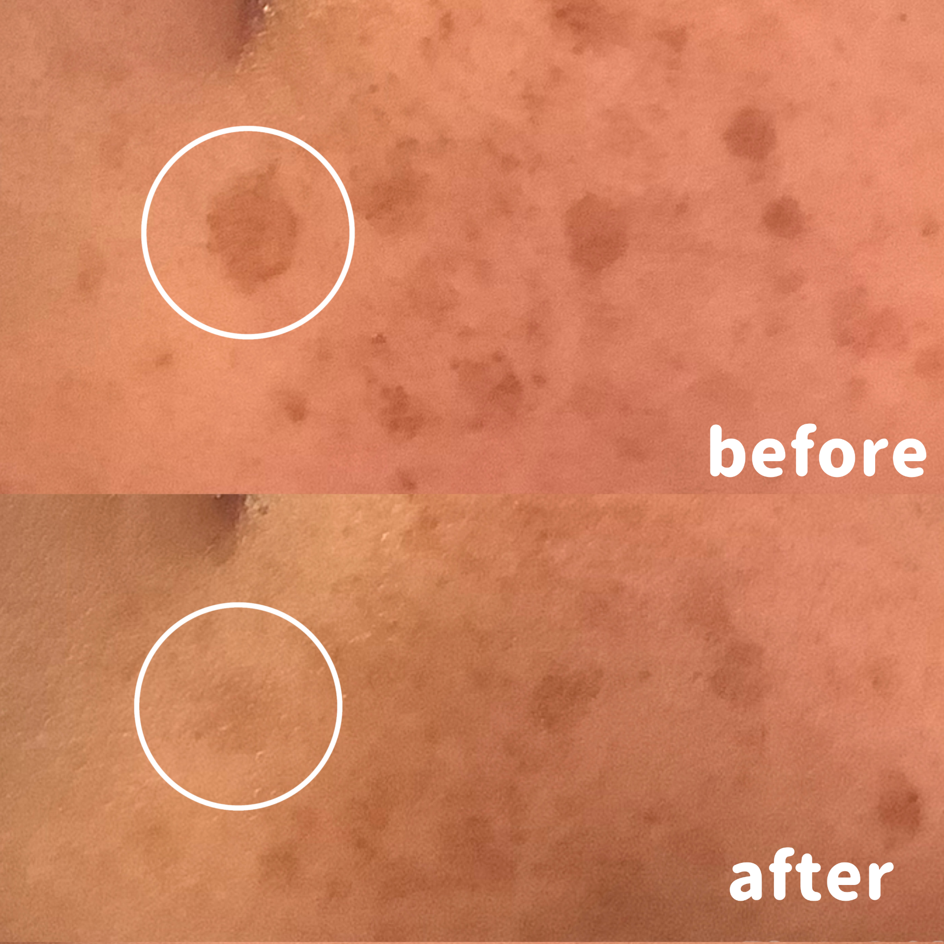 シミ取りエステ　シミエステ