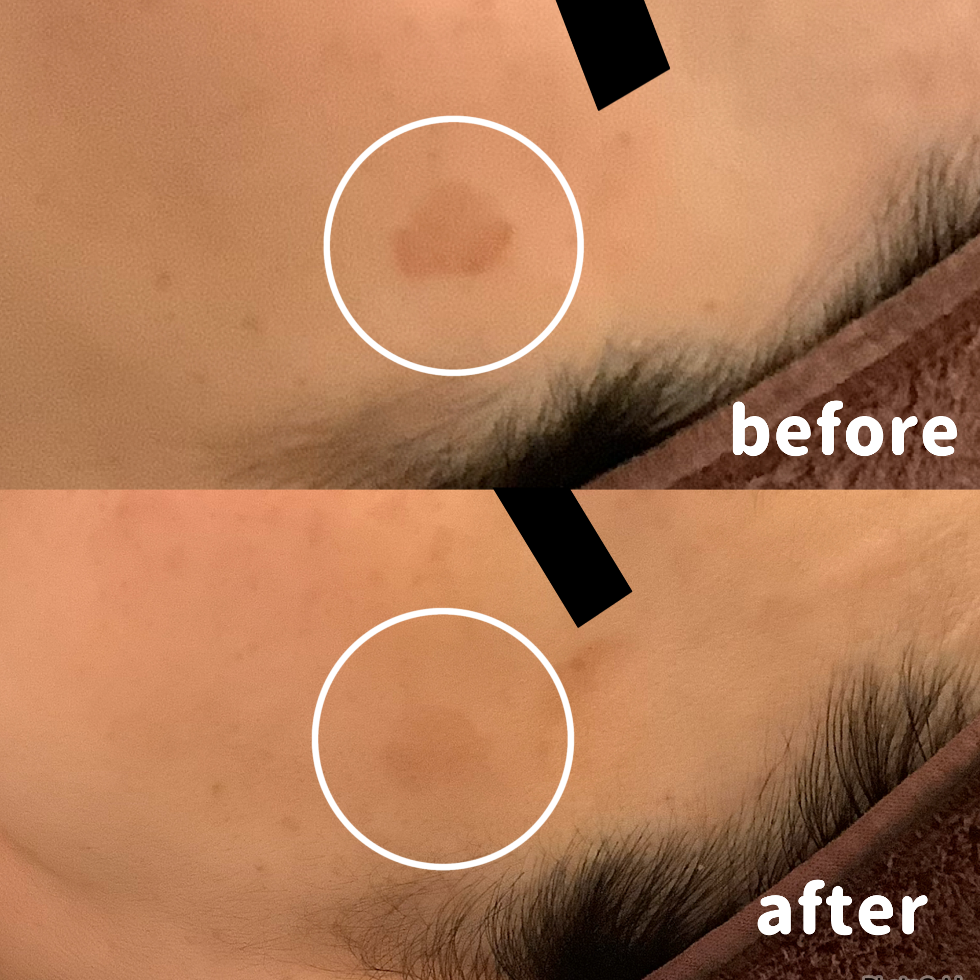 シミ取りエステ　シミ取りたい